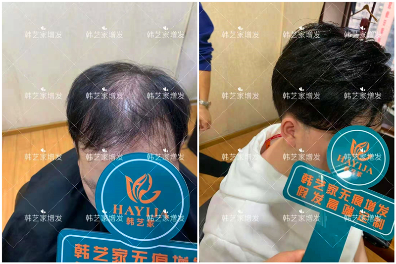 隐形密发增发
