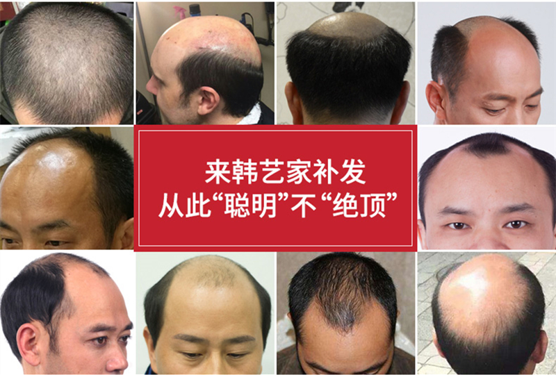 男士戴假发片舒服吗
