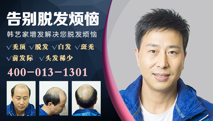 西安织发补发哪家好？增发需要多少钱？